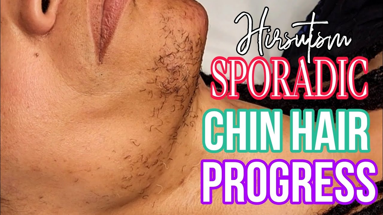 #Hirsutism SPORADIC Chin Hair Progress. Amazing Results!