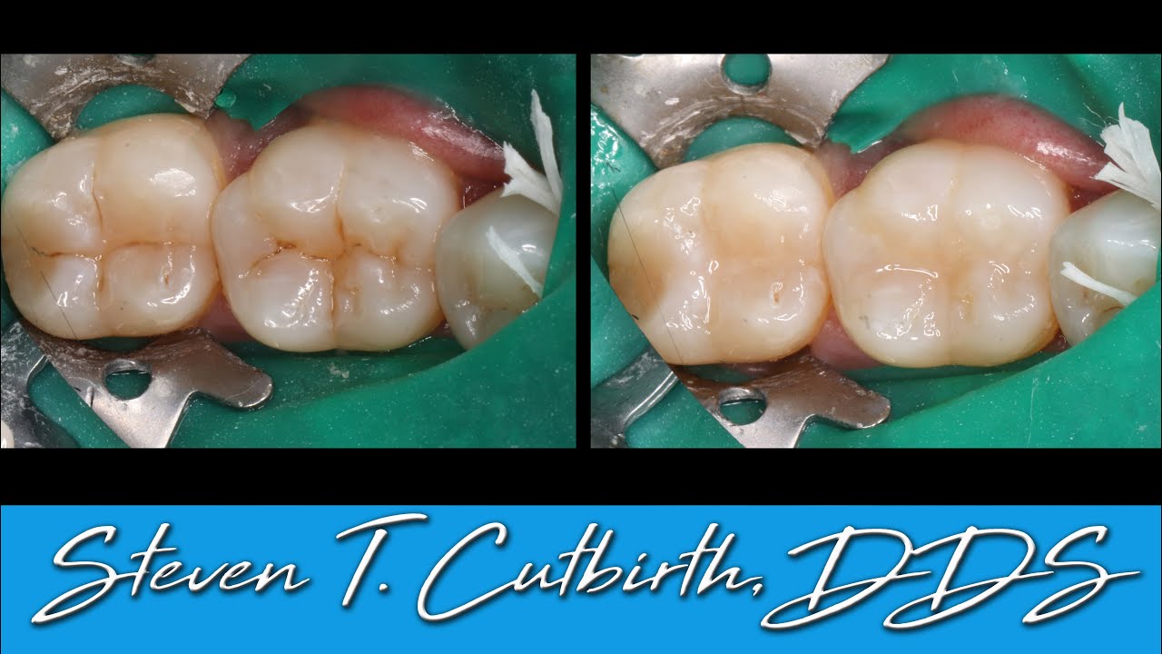 Why you Lost your Dental Sealants - Dental Minute with Steven T. Cutbirth, DDS