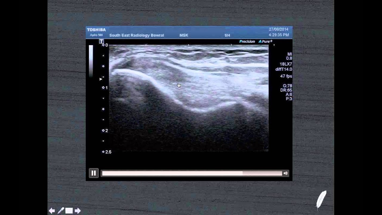 Comprehensive Elbow Pain Assessment with Stephen Bird