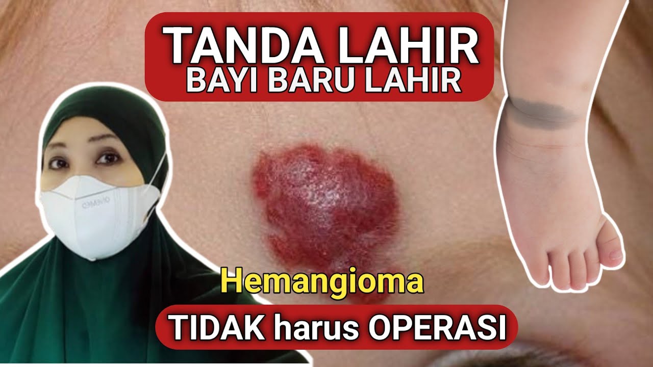 TANDA LAHIR ini TIDAK harus DI OPERASI - HEMANGIOMA PADA BAYI