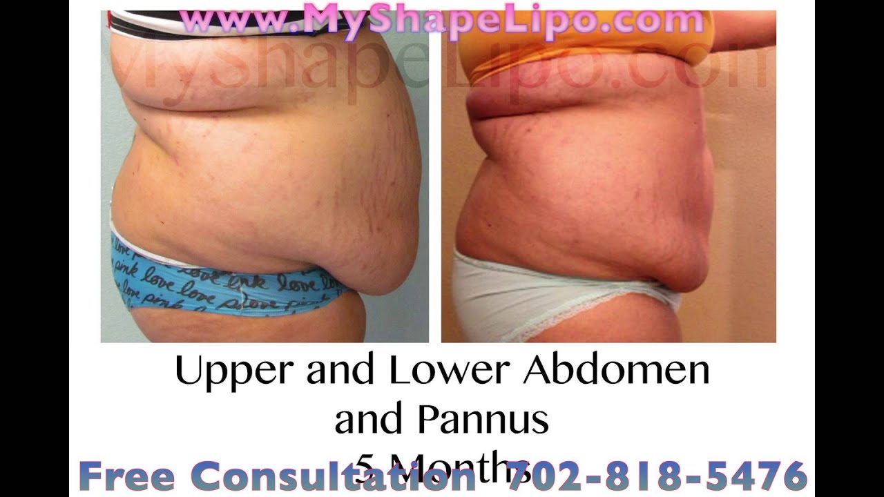 Large Volume Liposuction, Before and After, See Dramatic Results