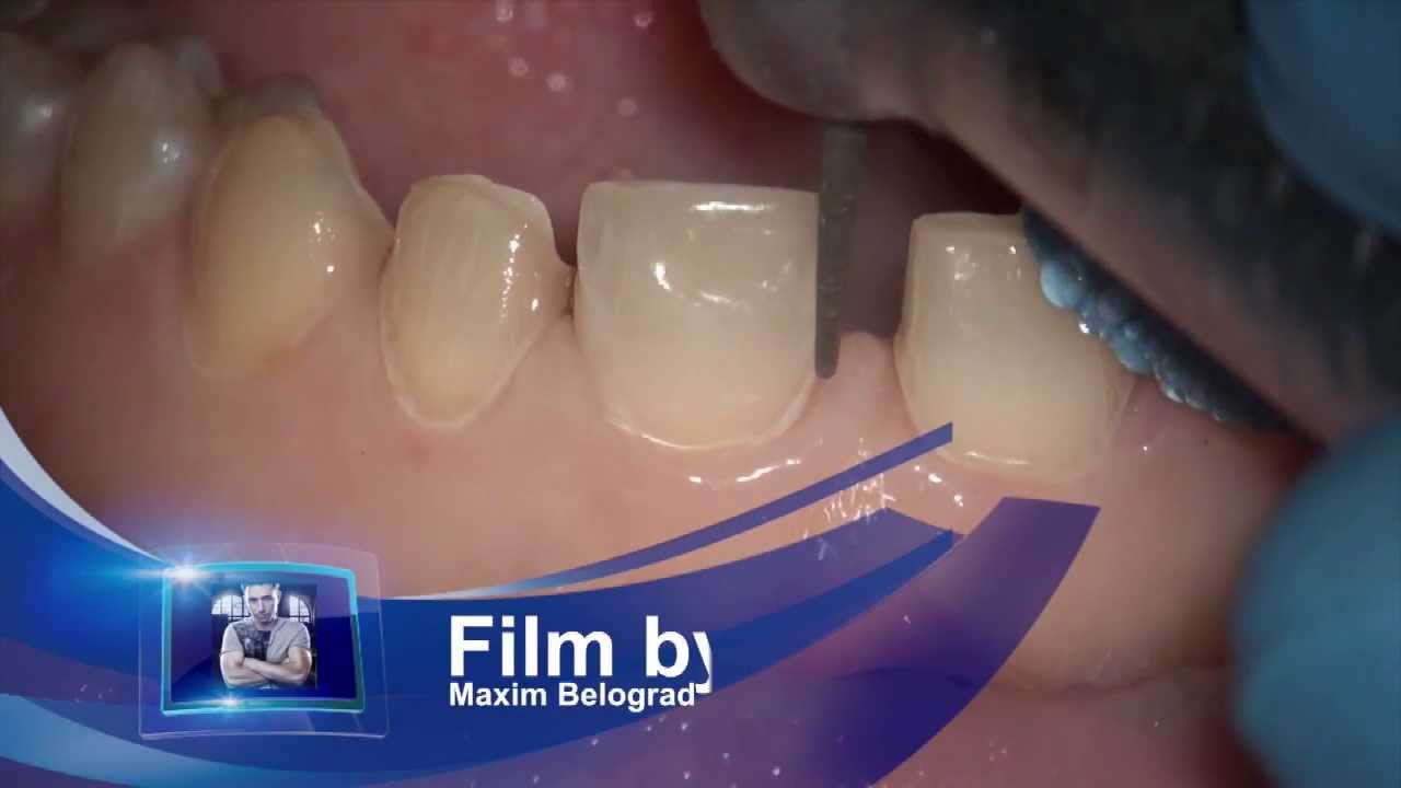 Veneers