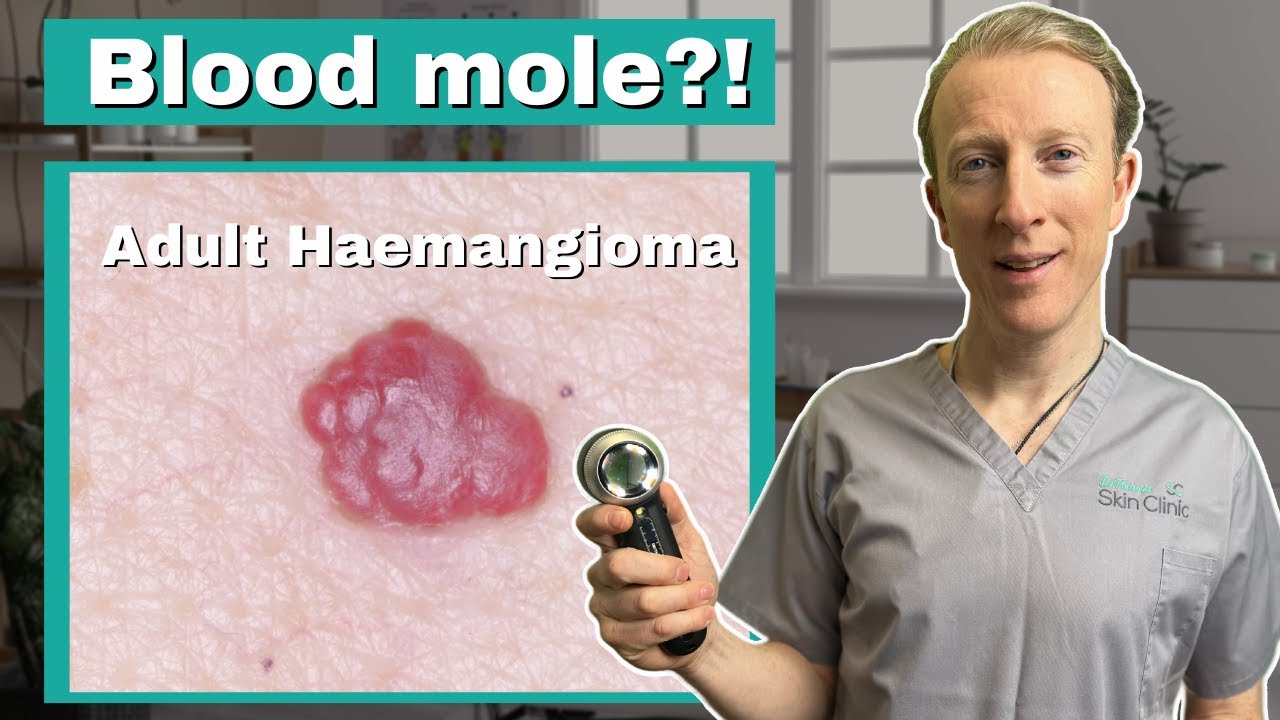 Гемангиома, возникающая у взрослых: врач объясняет, почему это не родинка!