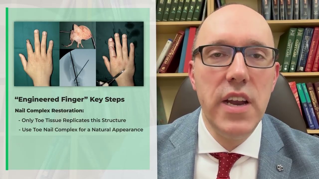 Engineered Fingers – A Toe Transfer Breakthrough by Antonio Rampazzo, MD, PhD