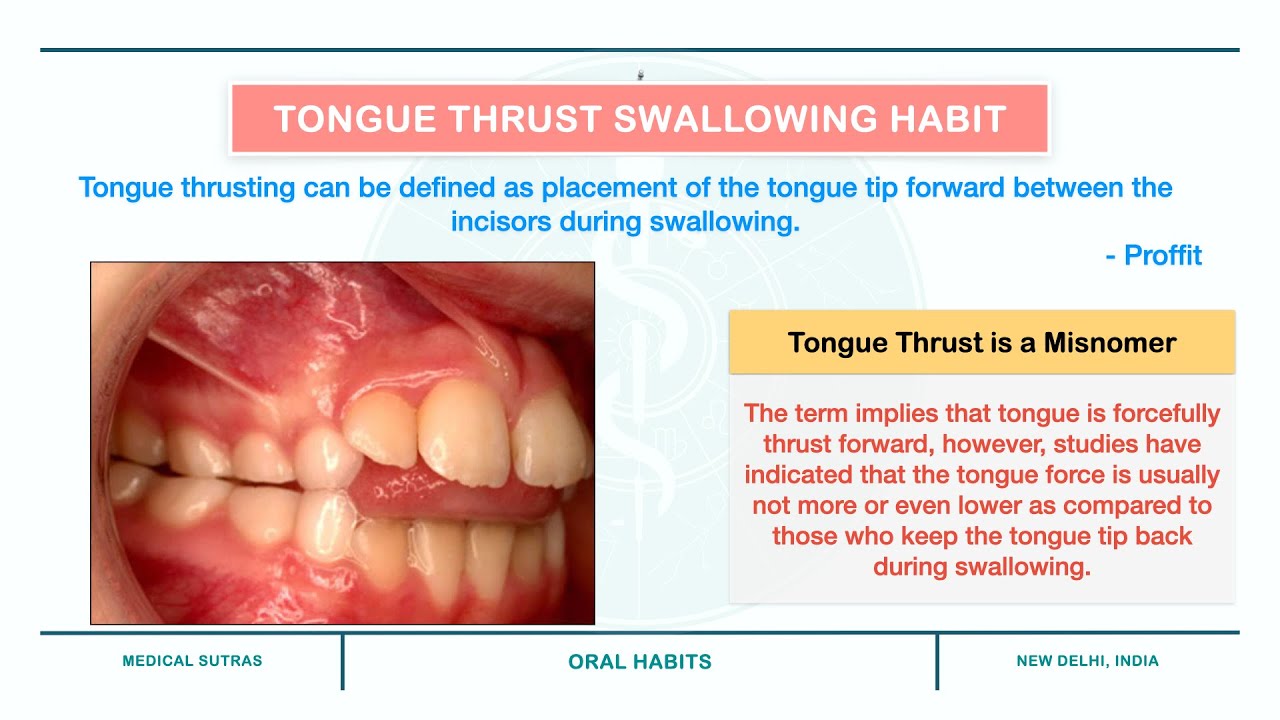 Tongue Thrusting | Oral Habits