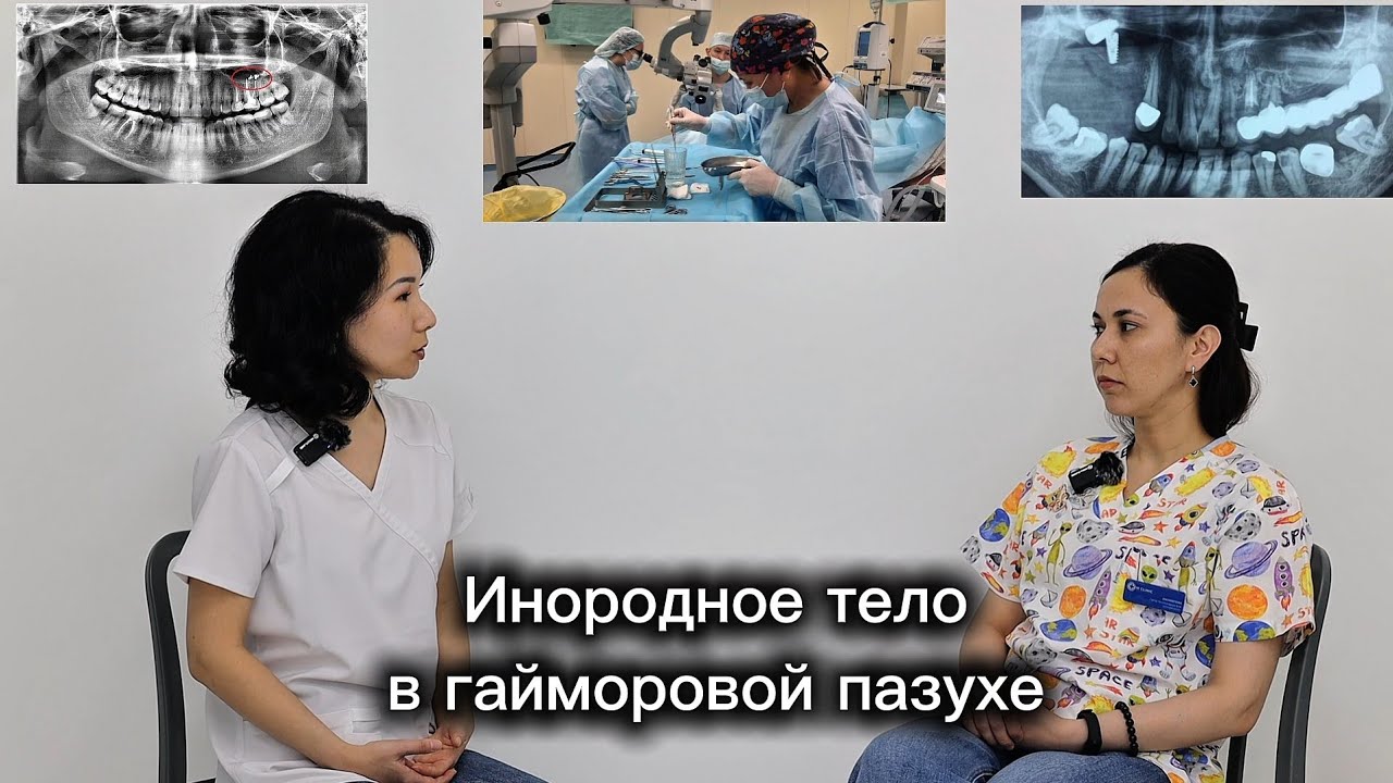 Перфорация гайморовой пазухи после удаления зуба. Инородное тело в гайморовой пазухе. Диагностика