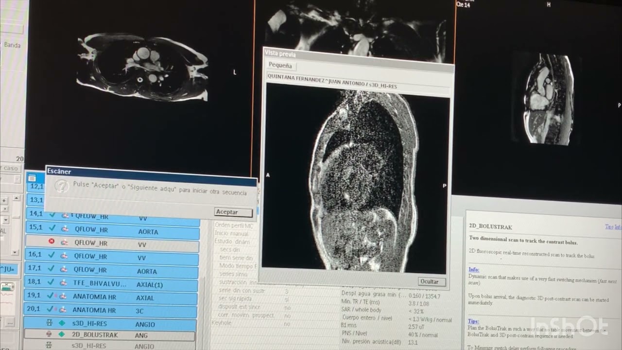 ANGIO RM AORTA TORÁCICA