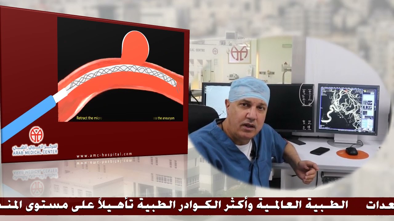 المركز العربي الطبي: علاج امهات الدم الدماغية بالقسطرة