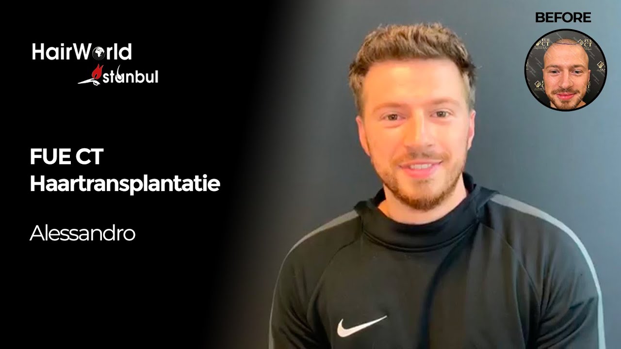 Cliëntervaring: de FUE CT haartransplantatie van Alessandro (6 van 9 maanden resultaat)