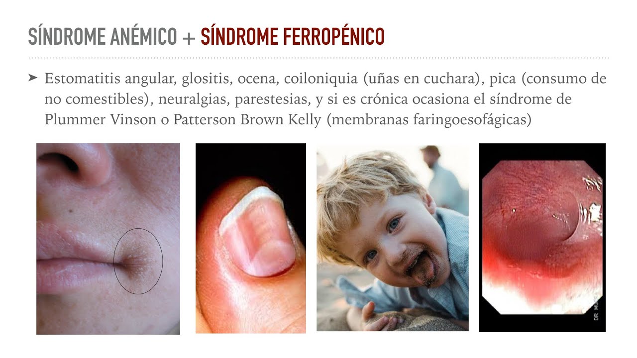 Anemia 2: Anemia ferropénica e inflamatoria
