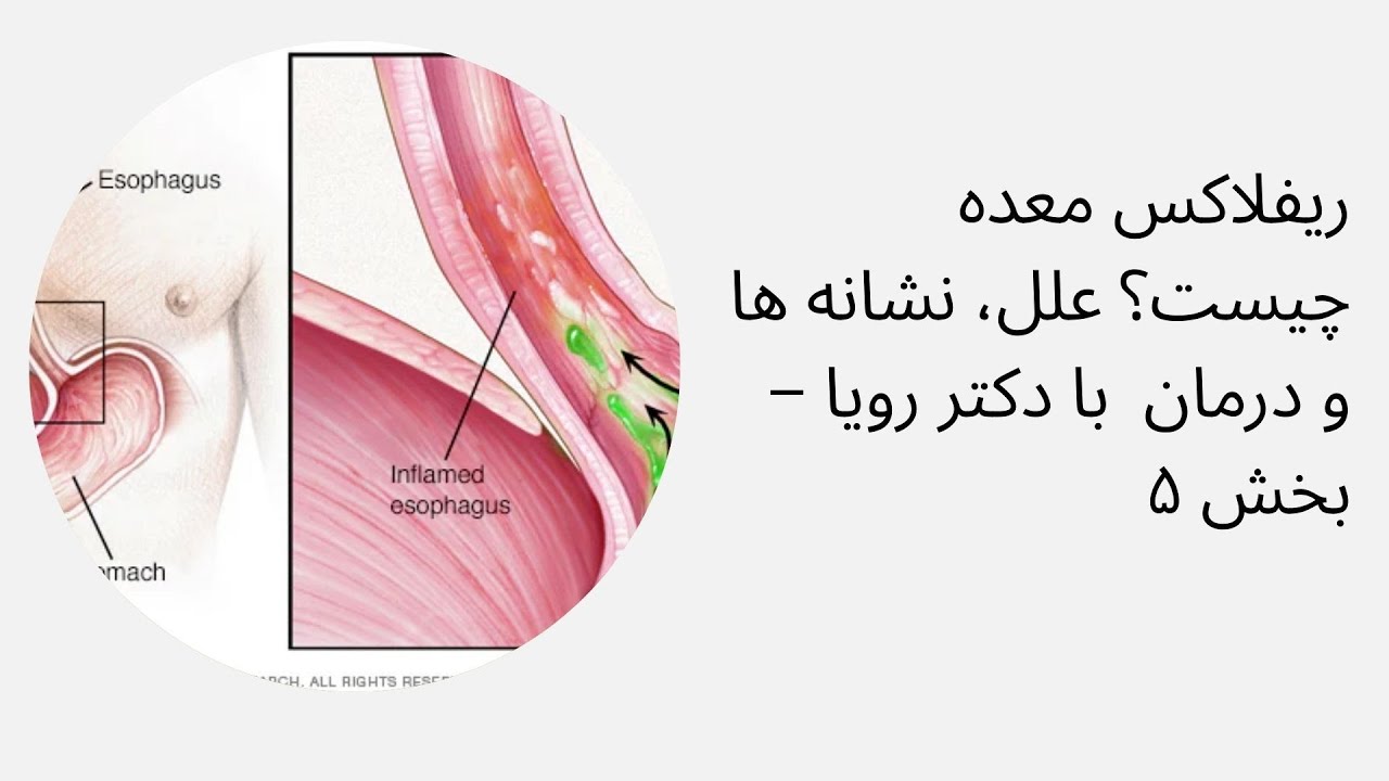 ریفلاکس معده چیست؟ علل، نشانه ها و درمان  با دکتر رویا – بخش ۵