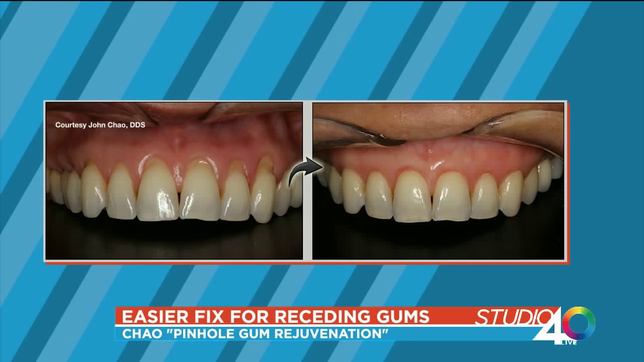 Chao Pinhole Gum Rejuvenation - Dr. Andrea Joy  Smith on FOX News