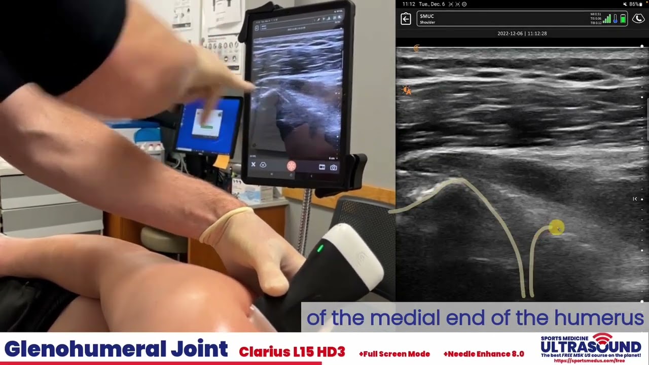 Glenohumeral Joint Injection Demonstration