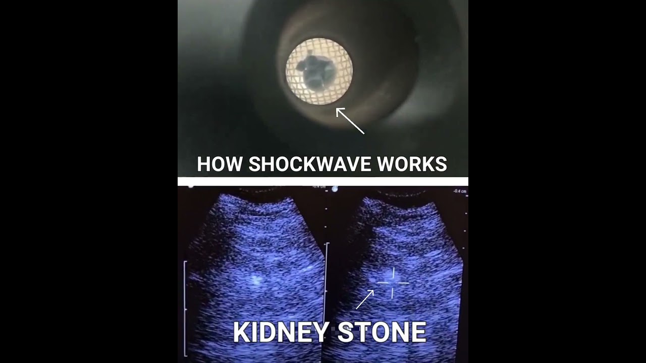 How ESWL (Extracorporeal Shockwave Lithotripsy) works?