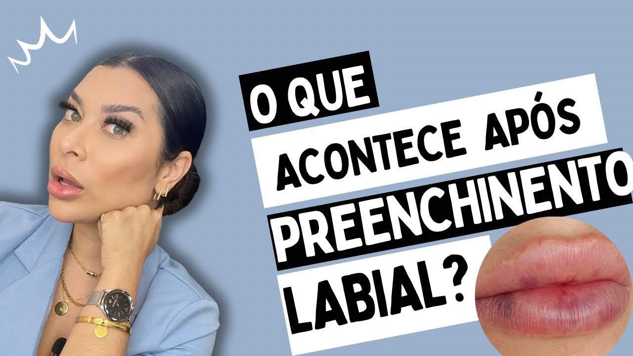 Preenchimento Labial: O que esperar logo após a aplicação?