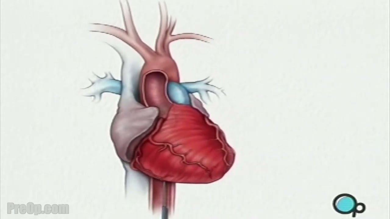 PreOp® Balloon Angioplasty Coronary Angioplasty