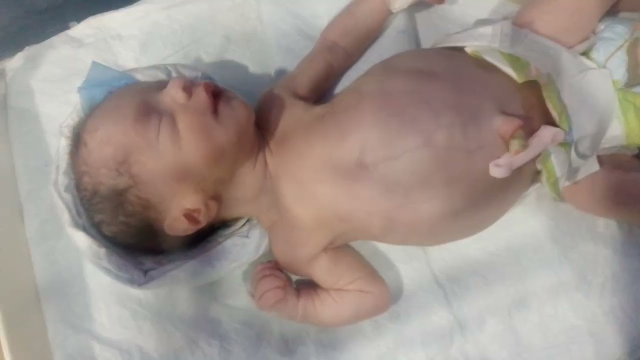 A baby with Hydronephrosis