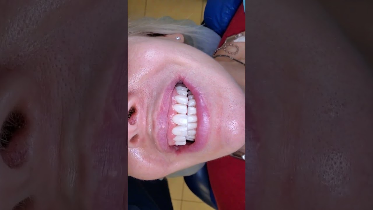 Временные пластмассовые виниры, подгонка формы перед постоянным протезированием. #тотал #зубы