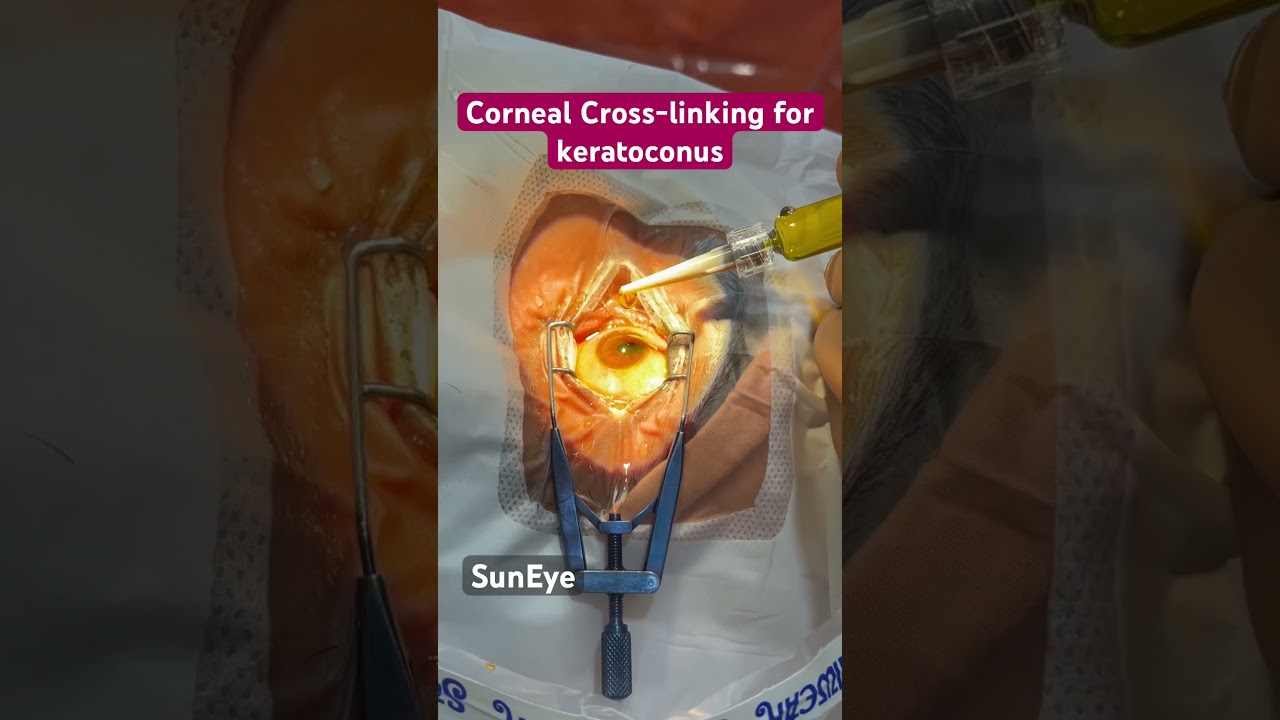 Treatment of keratoconus via Corneal Cross-linking #keratoconus #suneyecafe #eyecare