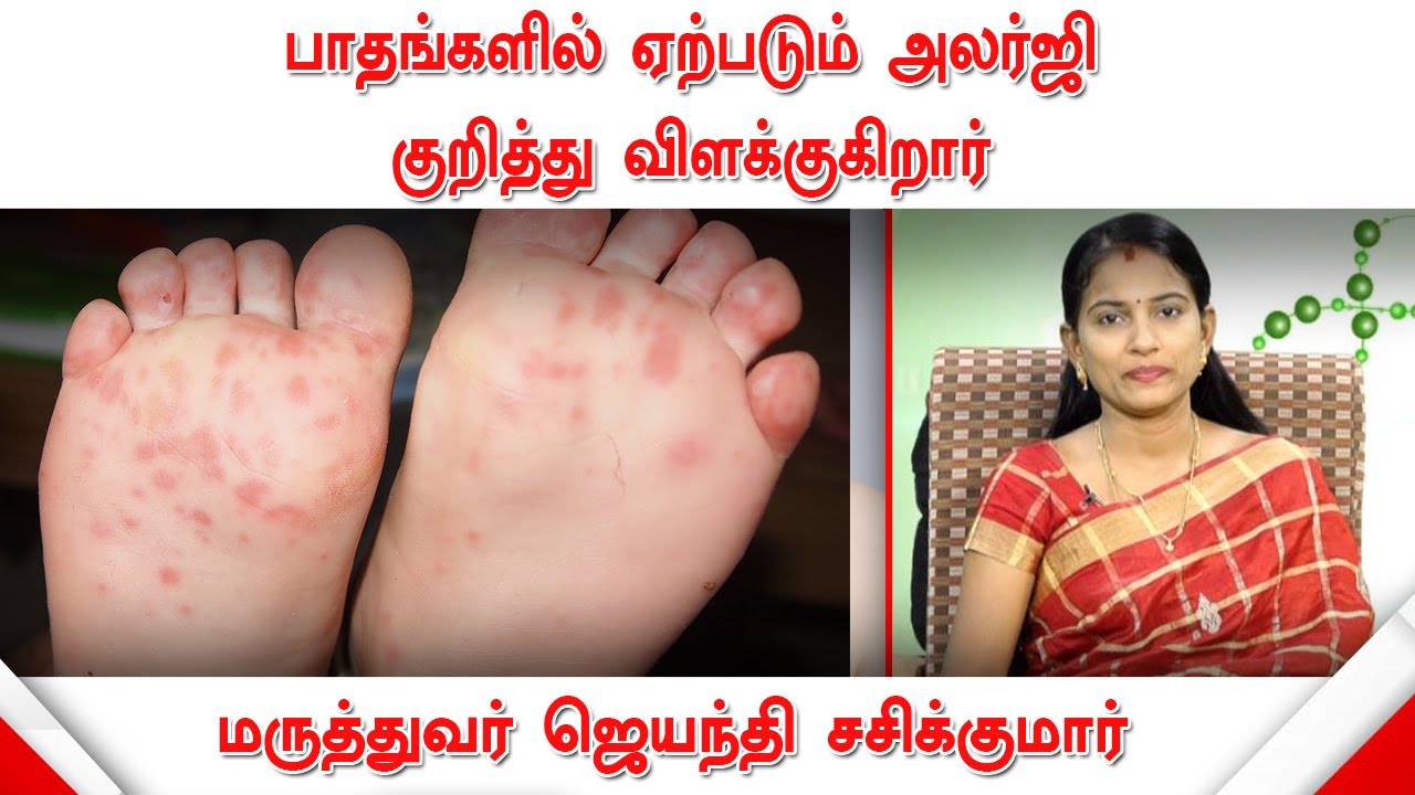 பாதங்களில் ஏற்படும் அலர்ஜி குறித்து விளக்குகிறார் ஹோமியோபதி மருத்துவர் ஜெயந்தி சசிகுமார்