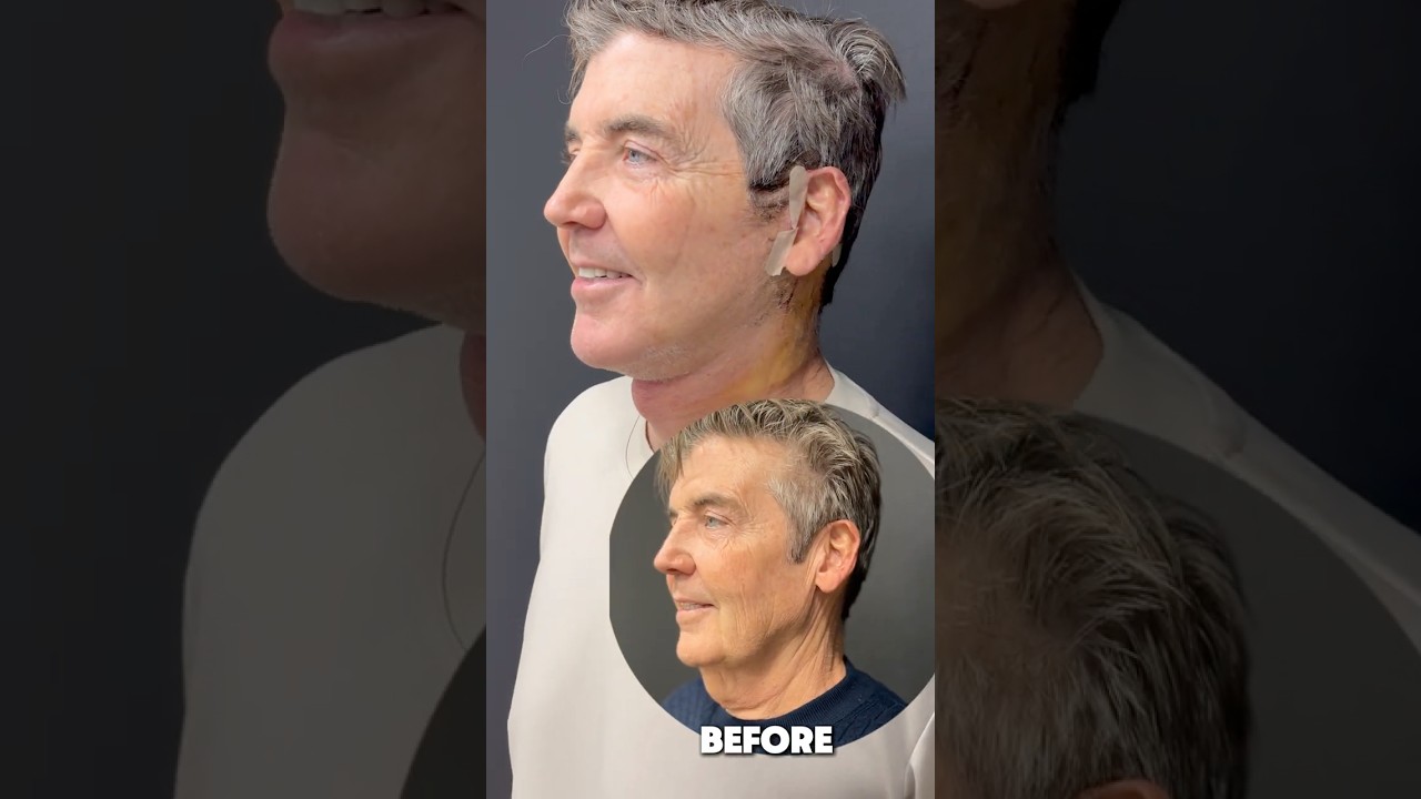 67 Year Old Man's Amazing Face & Neck Lift Result | Before & After  #necklift #turkeyneck #facelift