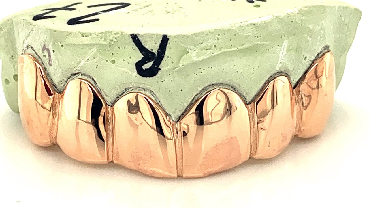 Can Gold Grillz Cover Missing Teeth by Seattle Gold Grills?