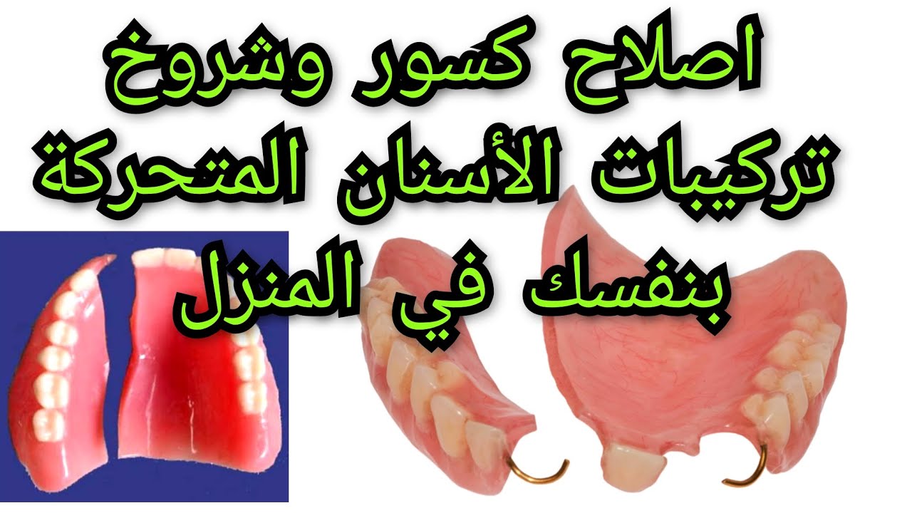 كيفية اصلاح كسور و شروخ طقم الأسنان المتحرك ( او سقوط سن )بنفسك في المنزل دون طبيب