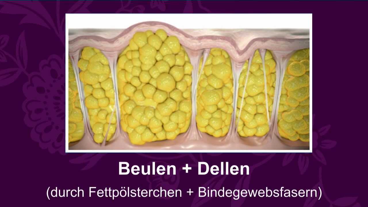 Cellulaze: Cellulitebehandlung mit dem Laser