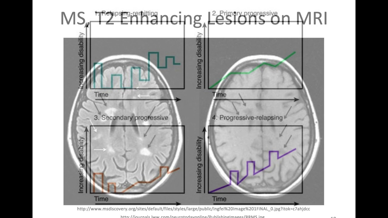 Neuro Infection, Autoimmune Disorders, and Neuropathies