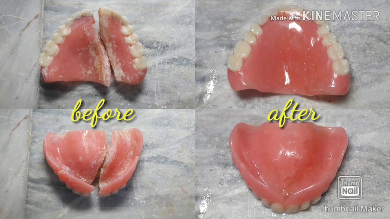 How to repair and clean a fractured complete  upper denture