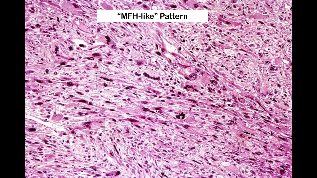 Common Morphologic Patterns in Soft Tissue Tumors by John R. Goldblum, M.D.