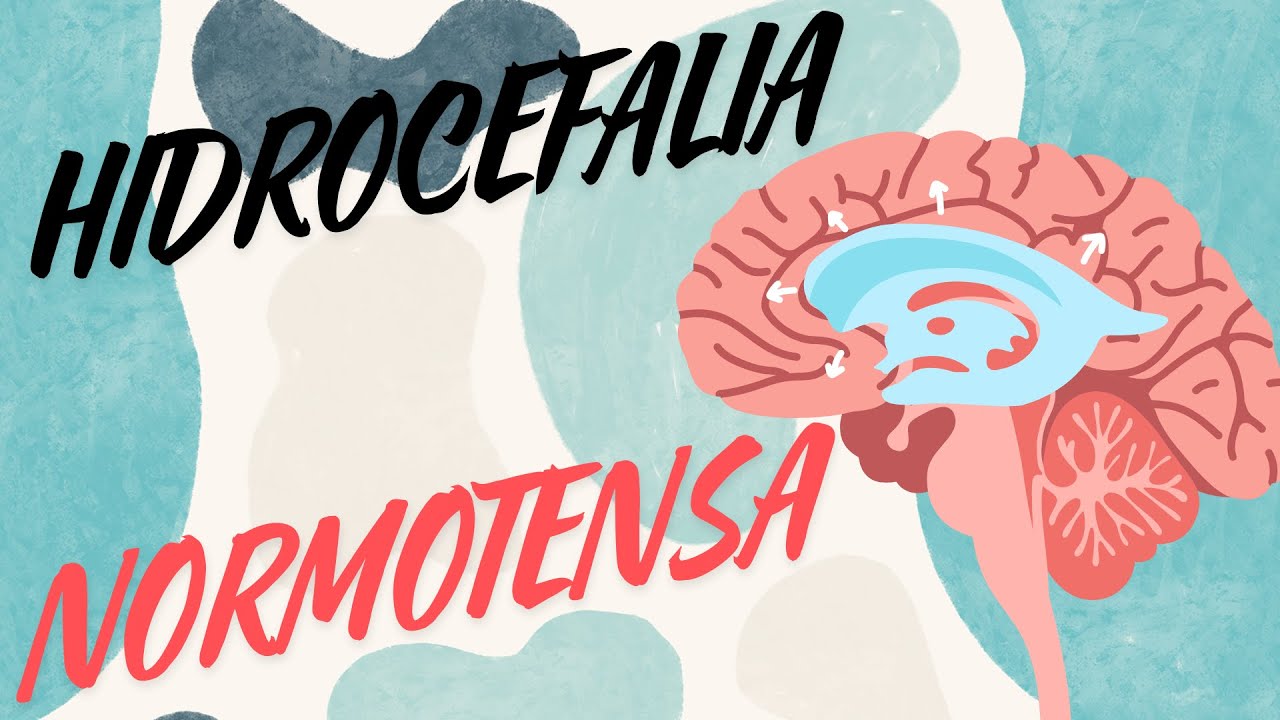 HIDROCEFALIA NORMOTENSA