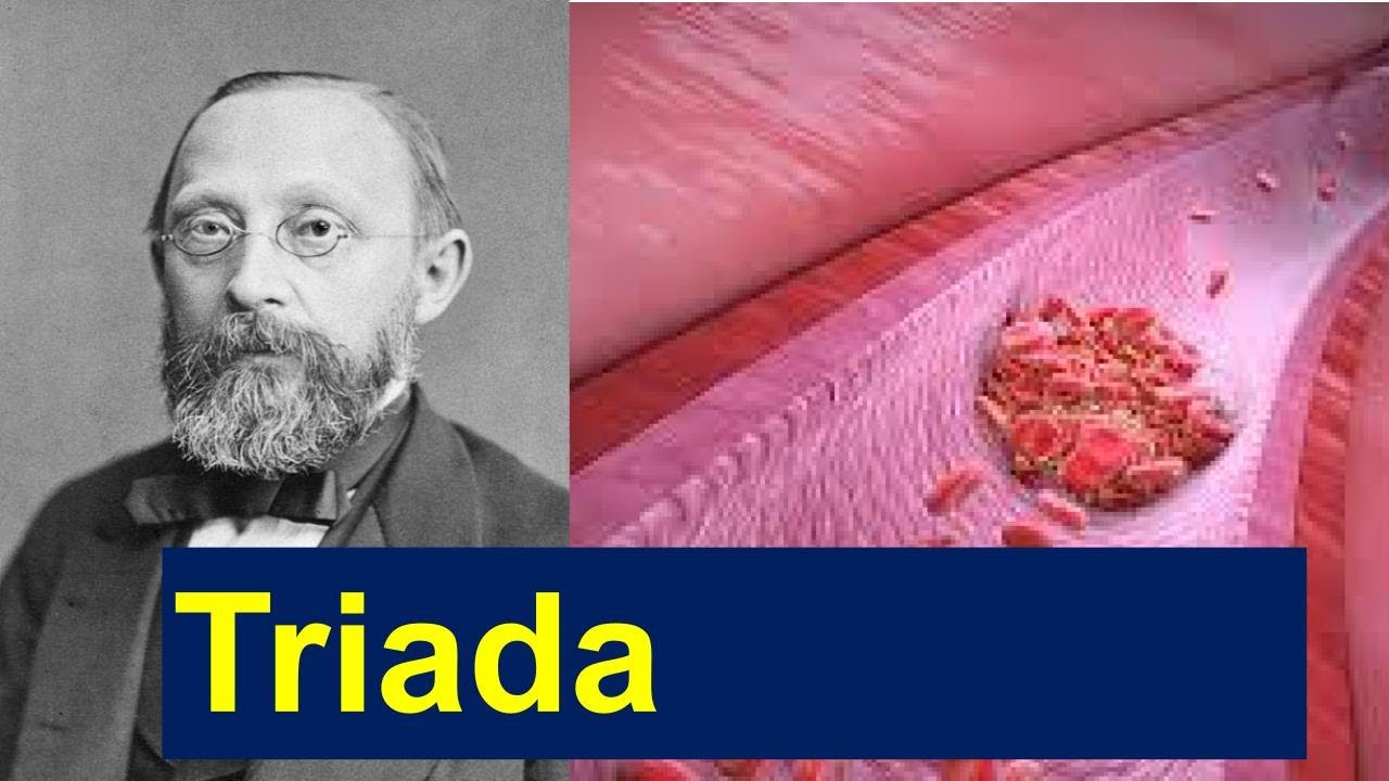Triada de Virchow