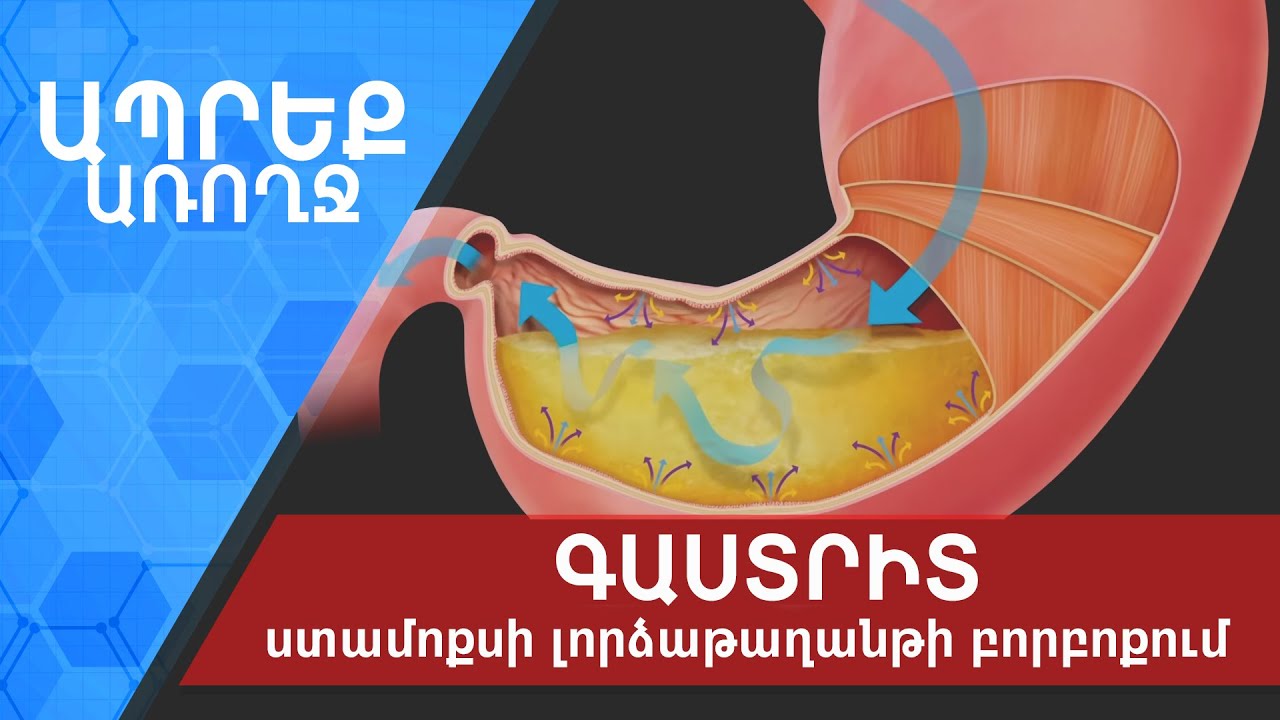 Ապրեք առողջ | Գաստրիտ կամ ստամոքսի լորձաթաղանթի բորբոքում