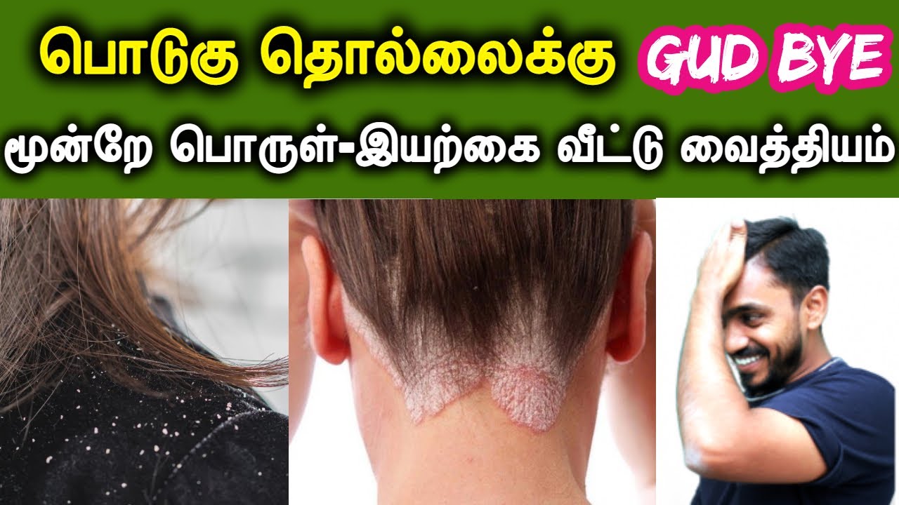 பொடுகு தொல்லை நிரந்தர தீர்வு | 3 பொருட்கள் 3 எளிய வழிகள்-  | DANDRUFF EASY HOME REMEDY | DrSJ