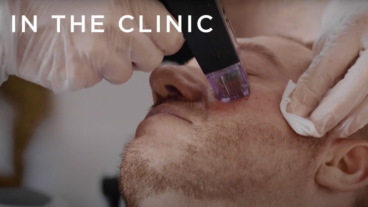 Botox, Fillers and Laser for Men - How to Not Look Weird