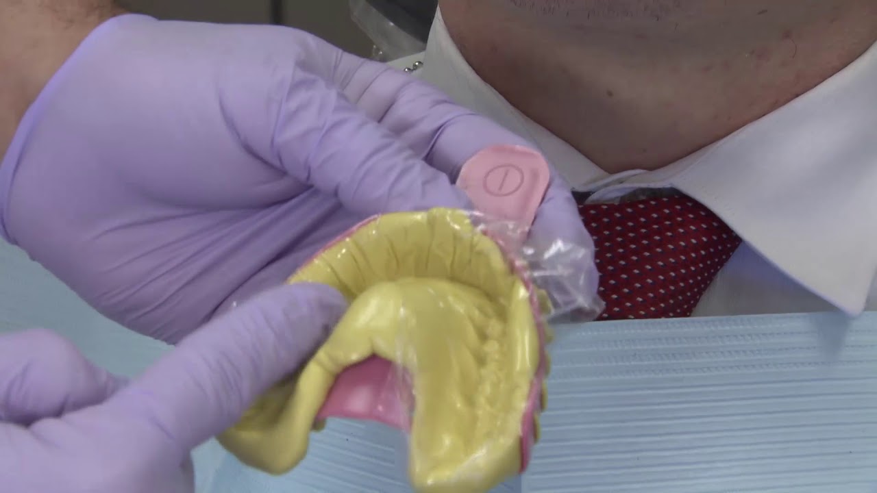 Case of the Week: A Tip for Full-Arch Impressions