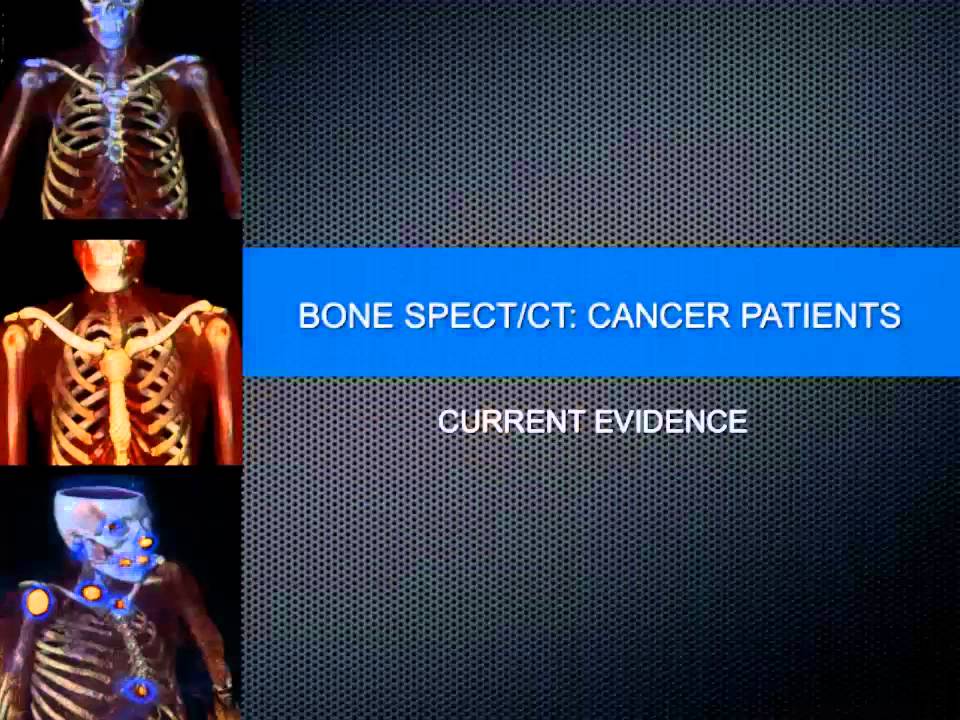 02 Bone SPECT CT in patients with cancer