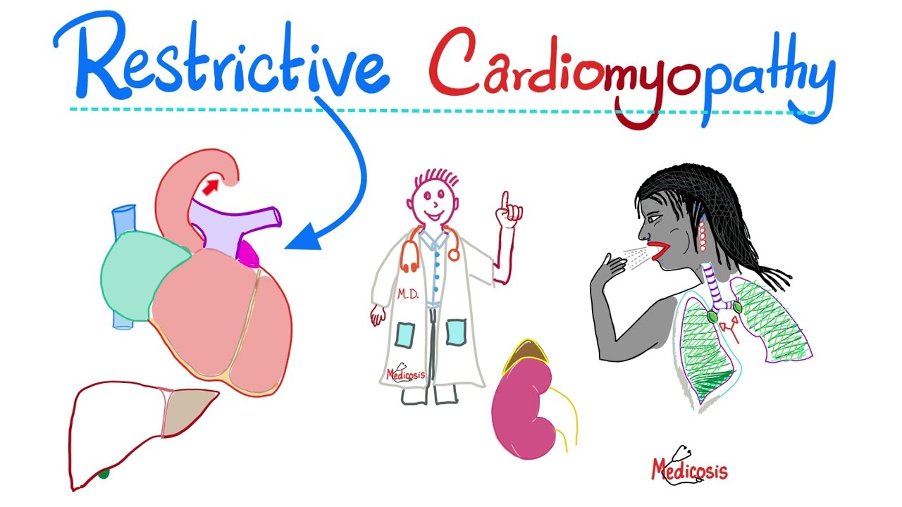 Restrictive Cardiomyopathy - Causes, Symptoms, Diagnosis & Treatment - Cardiology Series