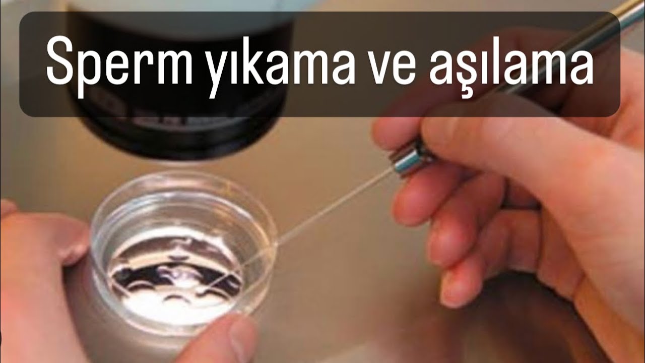 #semenanalizi #spermyumurtadonasyonu #spermanalysis #sperm        Sperm yıkama ve aşılama