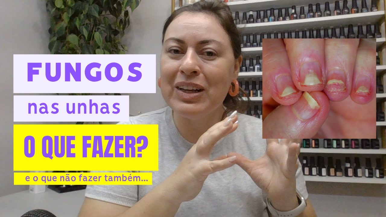 Fungos nas unhas | como tratar | o que fazer para não piorar
