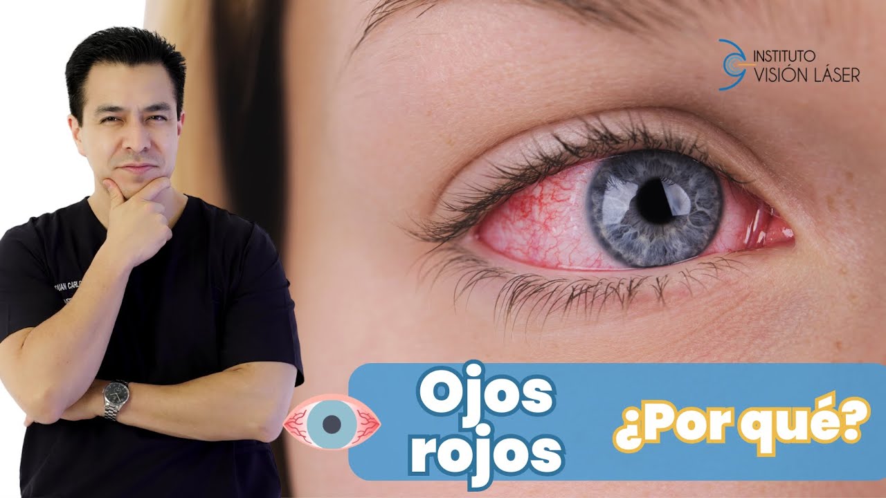 Ojos rojos ¿por qué?