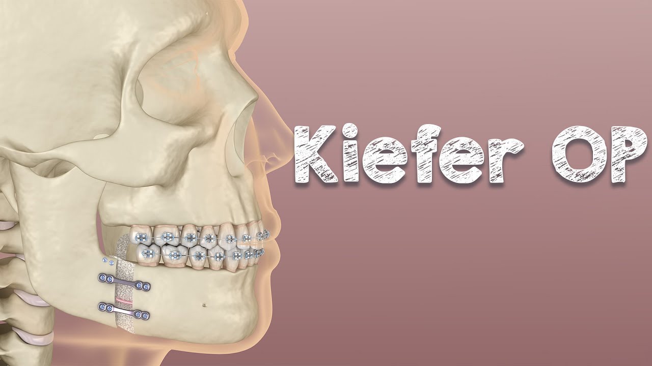 Kiefer Operation, BiMax: Risiko ohne Erfolgsgarantie und bleibenden Ursachen. Tue selbst was.