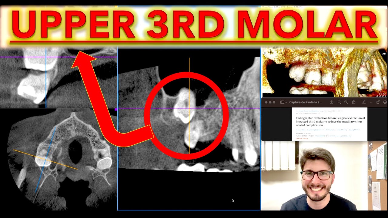 SURGICAL Planning of Impacted Maxillary Third Molars: CBCT technique, Upper 3rd molar surgery, sinus