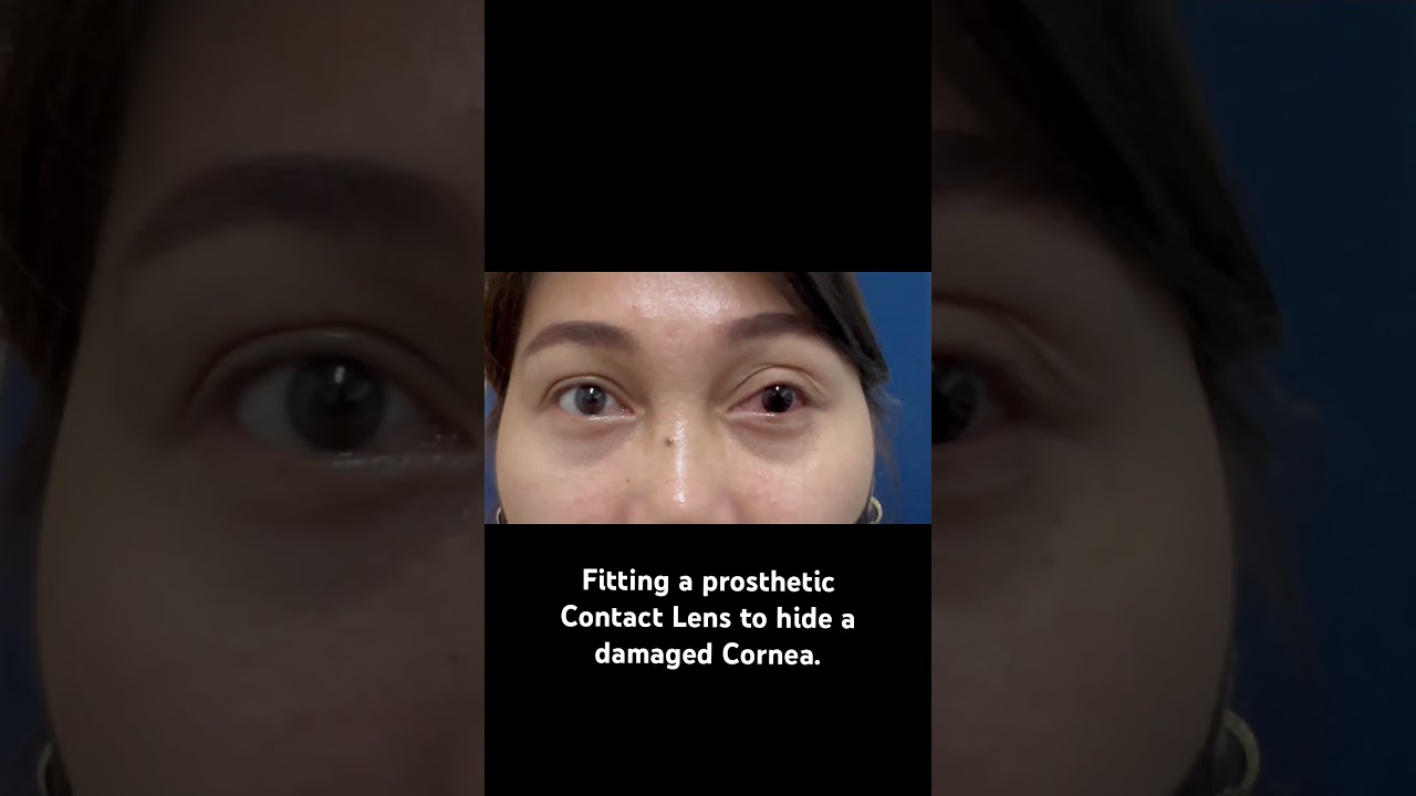 Hiding a damaged cornea using a prosthetic contact lens. #contactlens #optometrists #ocularist