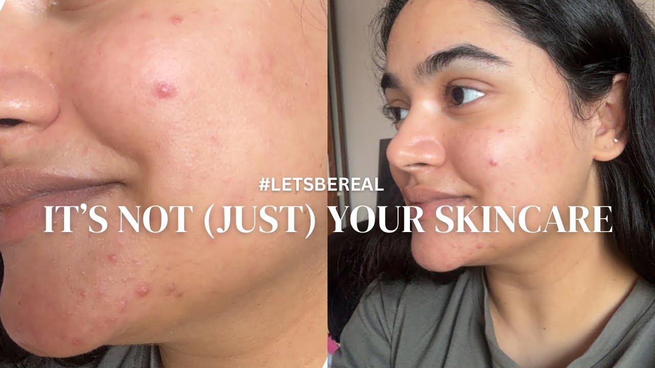 What if it’s not your skincare? The truth about your acne #acneproneskin #acnejourney 