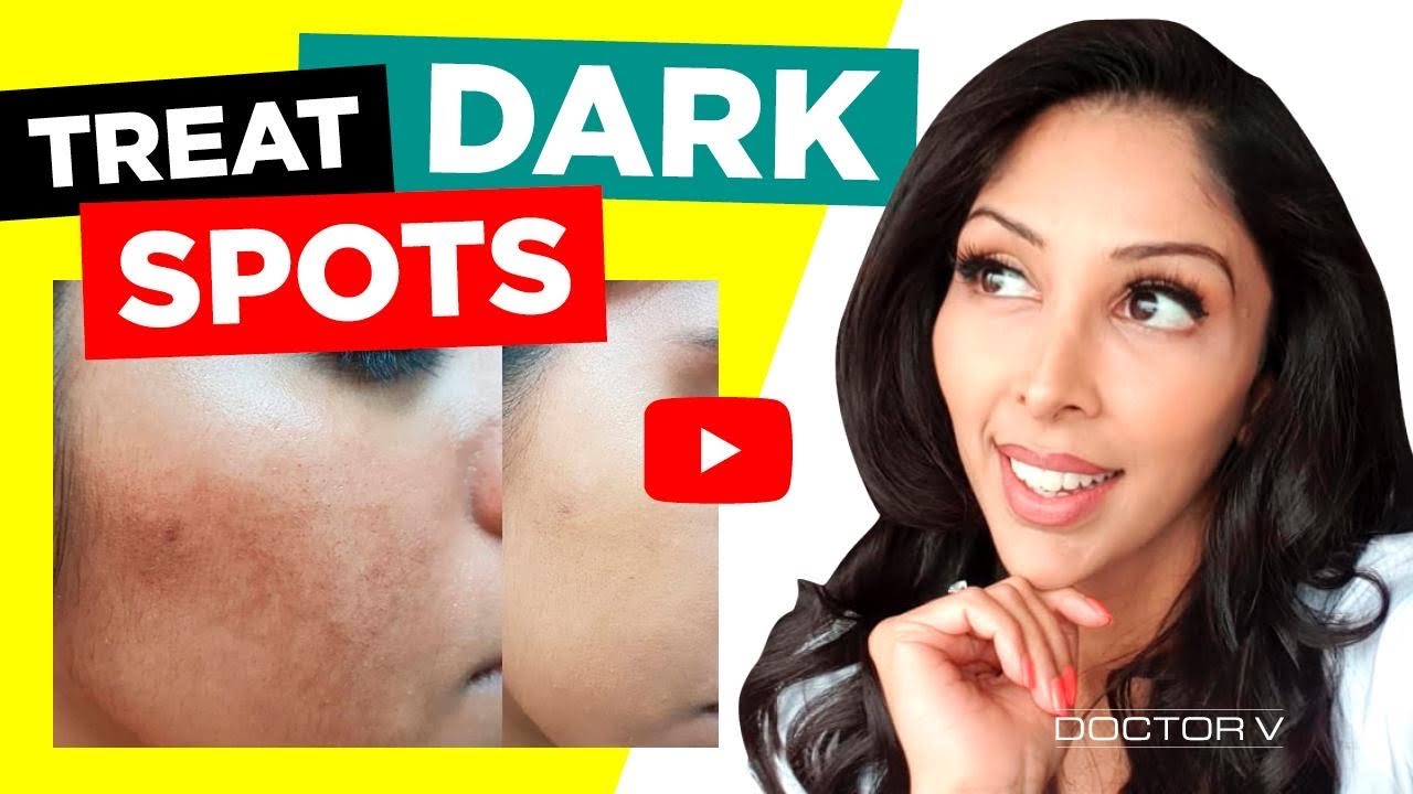 Doctor V - How To Treat Dark Marks For Skin Of Colour | Brown Or Black Skin