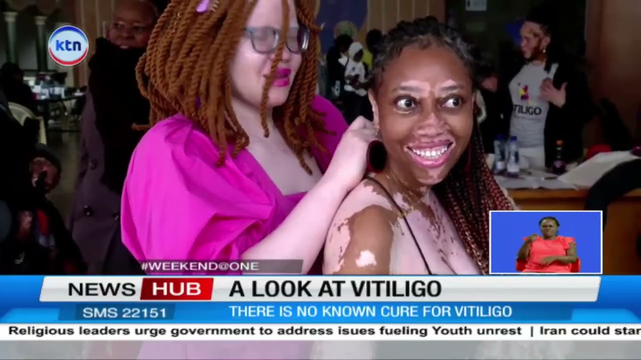 Vitiligo victims share life expriences of resilience battling the skin condition