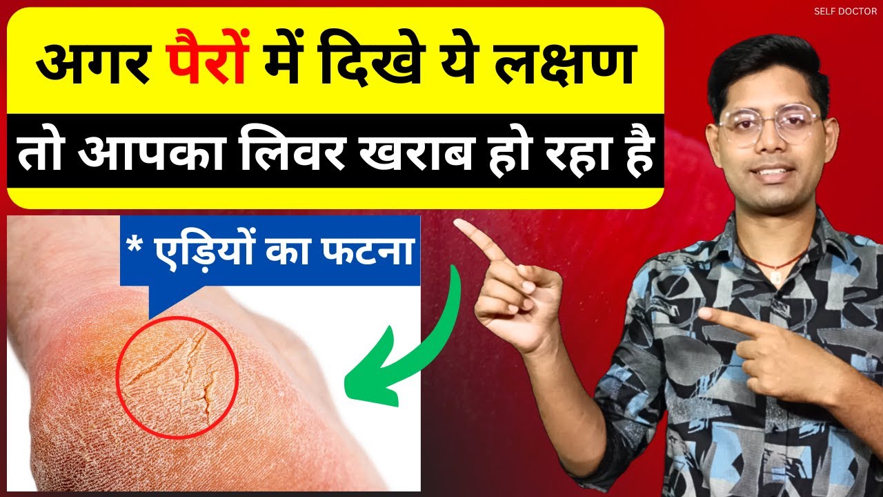 लिवर खराब होने के 4 शुरुआती लक्षण | liver kharab hone ke lakshan kya hai | SELF DOCTOR