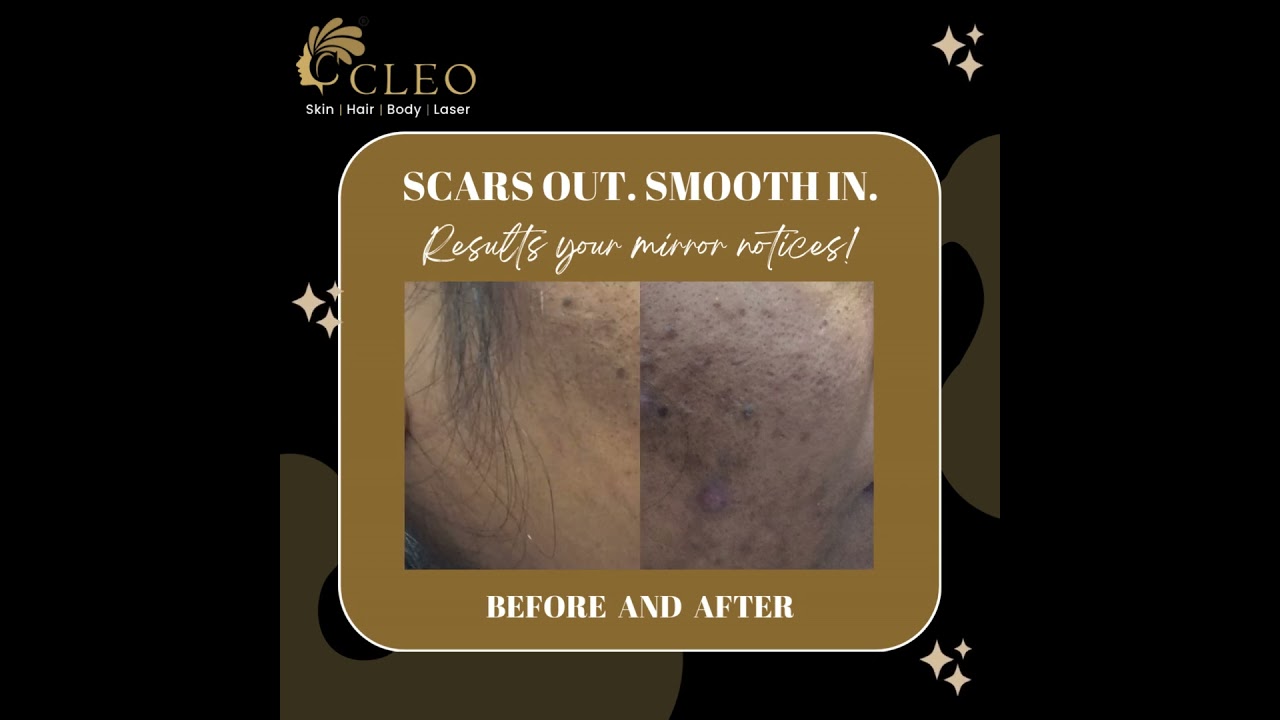 Acne Scar Treatment Results | Real Skin Transformation at Cleo